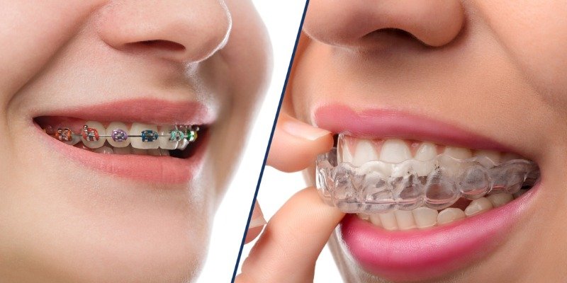Braces vs Aligners